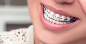 'Voorlichting over beugels nog altijd ondermaats'